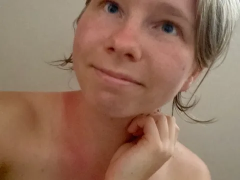 Sonnenbrand