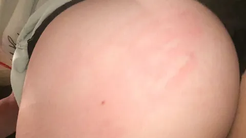 Ouch 🍑👋